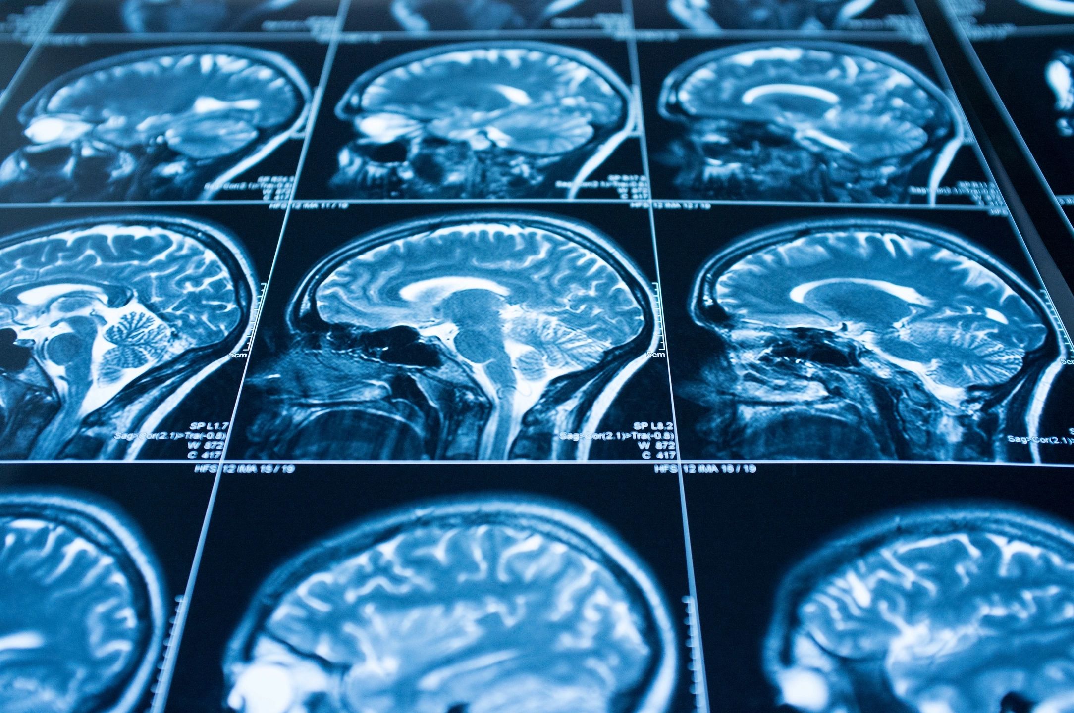 Neurology Clinical Trials